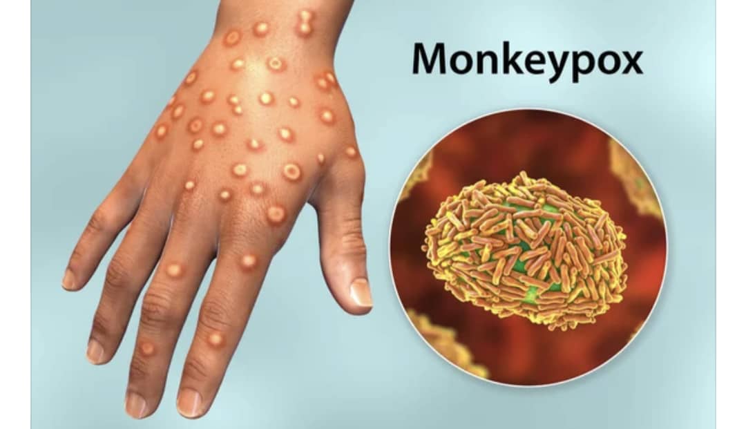 Lire la suite à propos de l’article Épidémie de Monkey Pox : 8 cas confirmés à Goma et ses alentours, voici comment vous protéger 