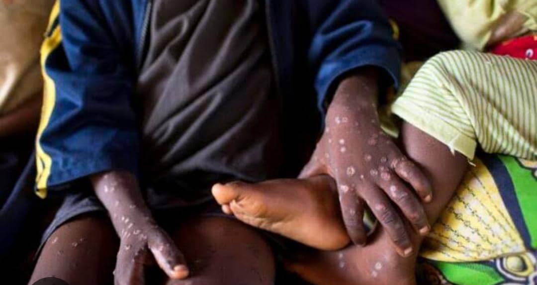 Lire la suite à propos de l’article Santé : Un million d’Euros fournit par l’UE pour contenir la propagation de la variole de Singe en RDC 