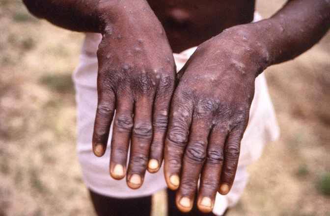 Lire la suite à propos de l’article Urgent : la Commune de Limete cité comme l’épicentre de l’épidémie Mpox