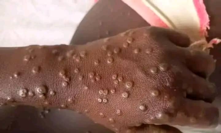 Lire la suite à propos de l’article Riposte contre le Mpox en RDC : un numéro vert mis à la disposition de la population