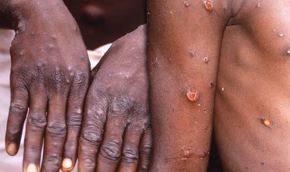 Lire la suite à propos de l’article MPOX: Avec des cas de contamination en hausse, Kinshasa risque d’être confinée (Analyse)