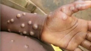 Lire la suite à propos de l’article Lutte contre la variole du singe : la RDC enregistre 1.006 décès 
