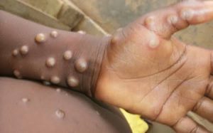 Lire la suite à propos de l’article Lutte contre la Mpox : La RDC et l’OMS s’engagent à garantir l’accès aux soins essentiels des patients