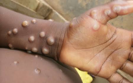 Lire la suite à propos de l’article Lutte contre la Mpox : La RDC et l’OMS s’engagent à garantir l’accès aux soins essentiels des patients