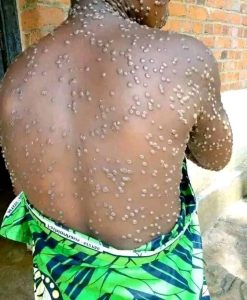 Lire la suite à propos de l’article RDC : 888 nouveaux cas suspects de Mpox enregistrés en une semaine