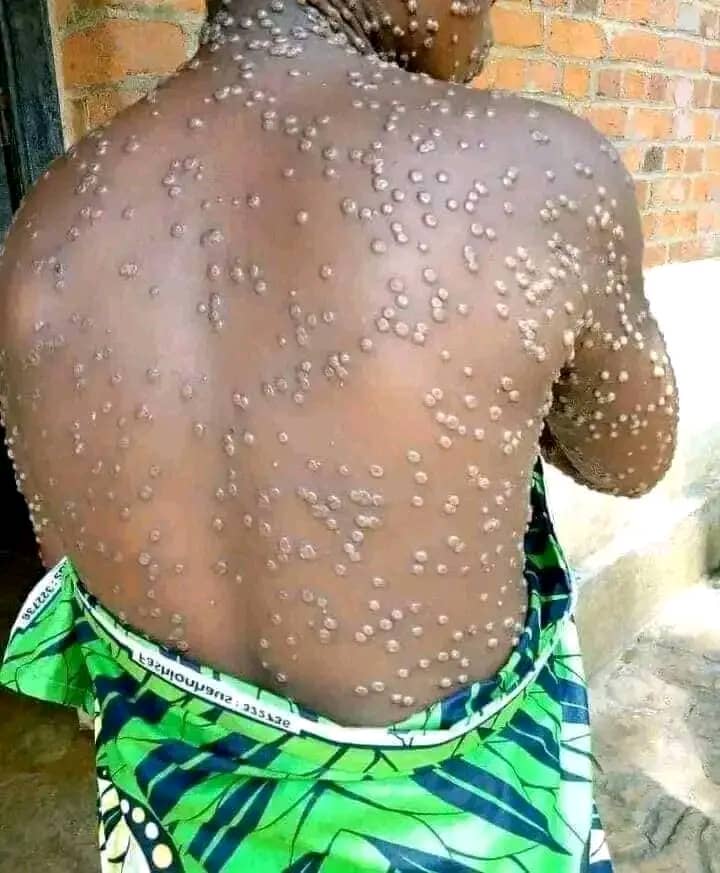 Lire la suite à propos de l’article RDC : 888 nouveaux cas suspects de Mpox enregistrés en une semaine